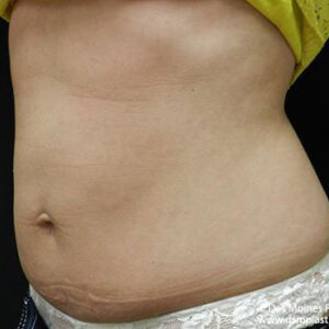 CoolSculpting before and after photos