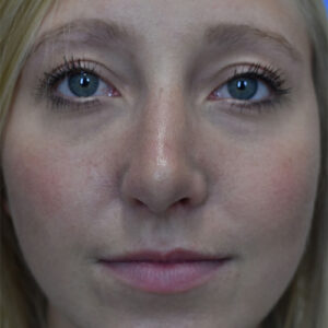 Rhinoplasty before and after photos