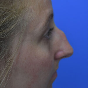 Rhinoplasty before and after photos