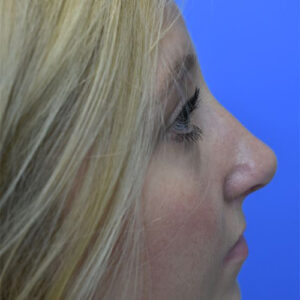 Rhinoplasty before and after photos