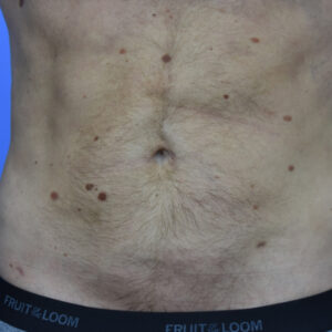 Liposuction before and after photos