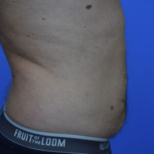 Liposuction before and after photos