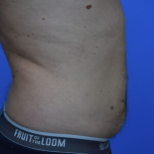 Liposuction before and after photos