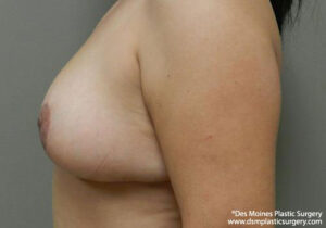 Breast Reduction before and after photos