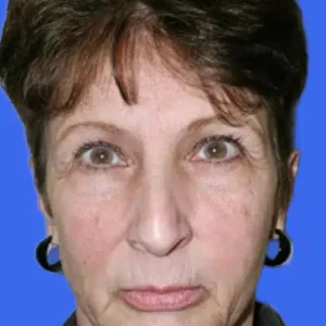 Brow Lift before and after photos
