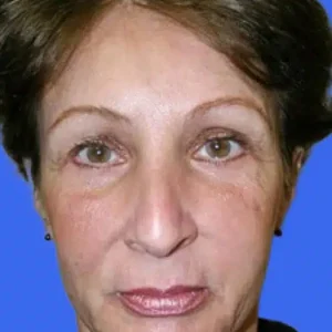 Brow Lift before and after photos