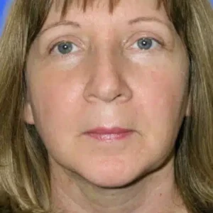 Neck Liposuction before and after photos