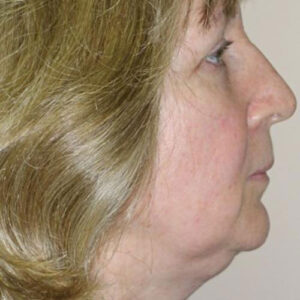 Neck Liposuction before and after photos