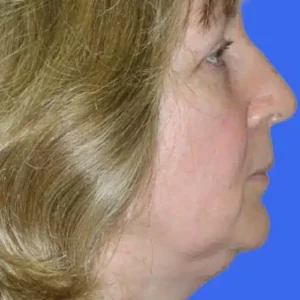 Neck Liposuction before and after photos