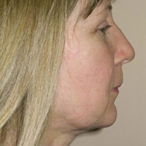 Neck Liposuction before and after photos