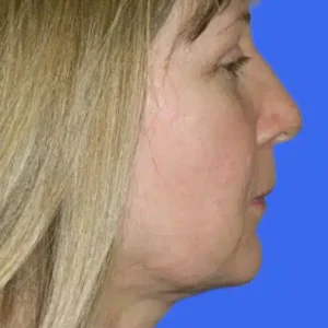 Neck Liposuction before and after photos
