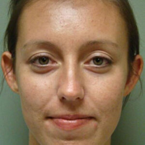 Ear Surgery before and after photos