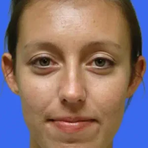 Ear Surgery before and after photos