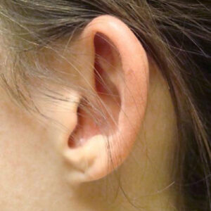 Ear Surgery before and after photos