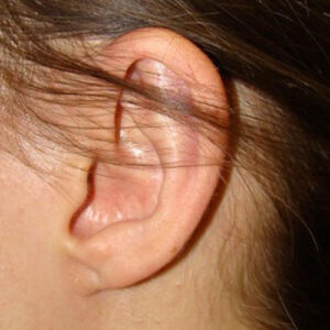 Ear Surgery before and after photos