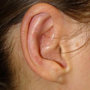 Ear Surgery before and after photos