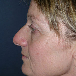 Face Lift before and after photos