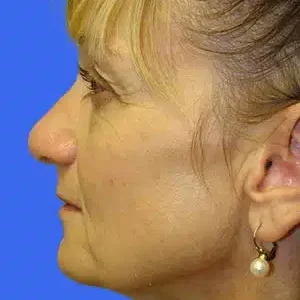 Face Lift before and after photos