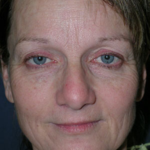 Face Lift before and after photos