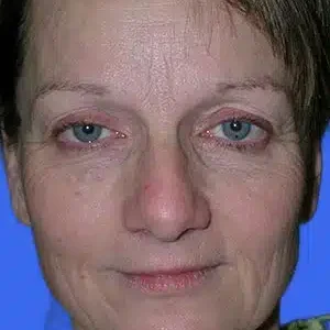 Face Lift before and after photos