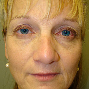 Face Lift before and after photos