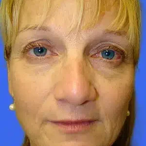 Face Lift before and after photos