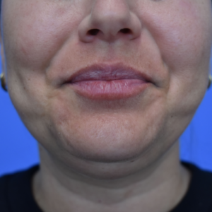 Laser Lift before and after photos