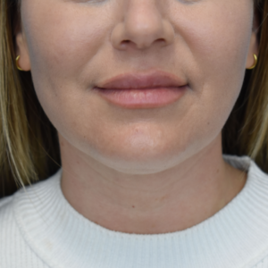 Laser Lift before and after photos