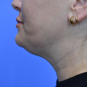 Laser Lift before and after photos