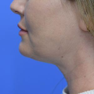 Laser Lift before and after photos