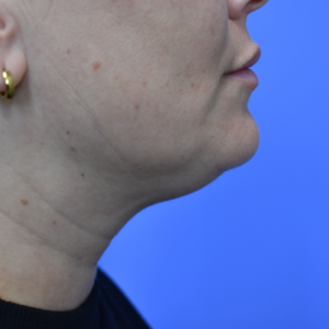 Laser Lift before and after photos