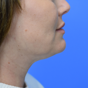 Laser Lift before and after photos