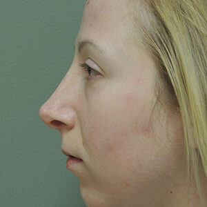 Chin Augmentation before and after photos