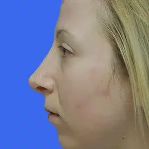 Chin Augmentation before and after photos
