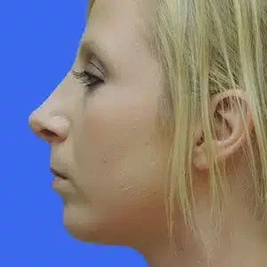 Chin Augmentation before and after photos