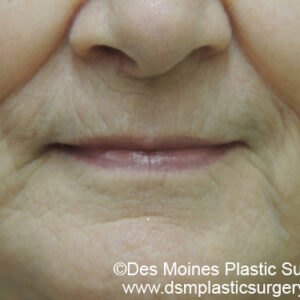 Laser Skin Resurfacing before and after photos