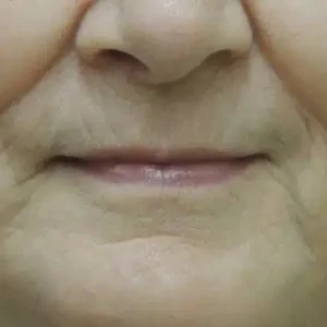 Laser Skin Resurfacing before and after photos