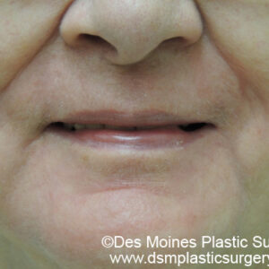 Laser Skin Resurfacing before and after photos