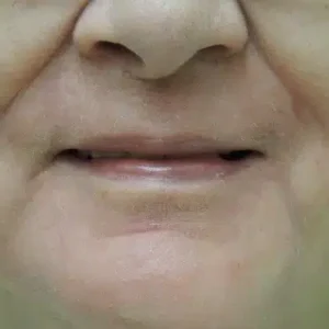 Laser Skin Resurfacing before and after photos