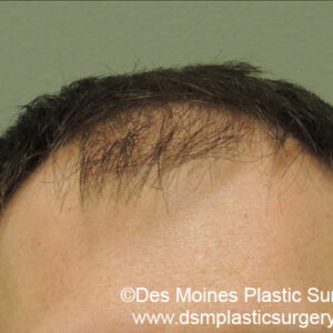 Neograft Hair Loss Replacement before and after photos