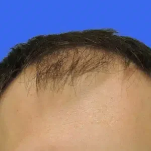 Neograft Hair Loss Replacement before and after photos