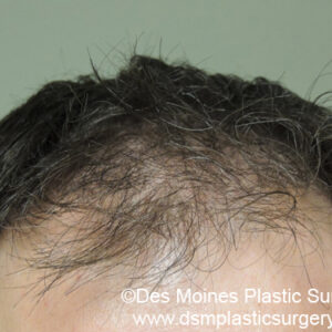 Neograft Hair Loss Replacement before and after photos