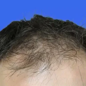 Neograft Hair Loss Replacement before and after photos