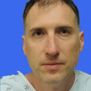 Neograft Hair Loss Replacement before and after photos