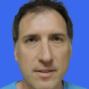 Neograft Hair Loss Replacement before and after photos