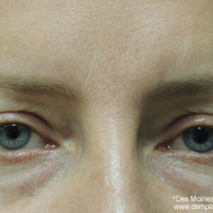 Eyelid Surgery before and after photos