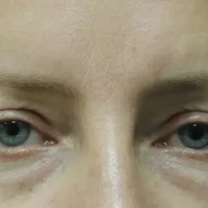 Eyelid Surgery before and after photos
