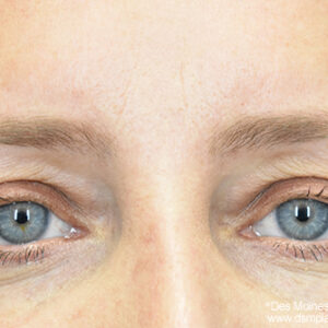 Eyelid Surgery before and after photos