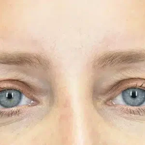 Eyelid Surgery before and after photos