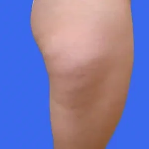 Liposuction before and after photos Liposuction before and after photos